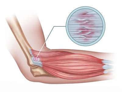 Will my Tennis Elbow Ever Go Away? Exercise for Rehabilitation and Health